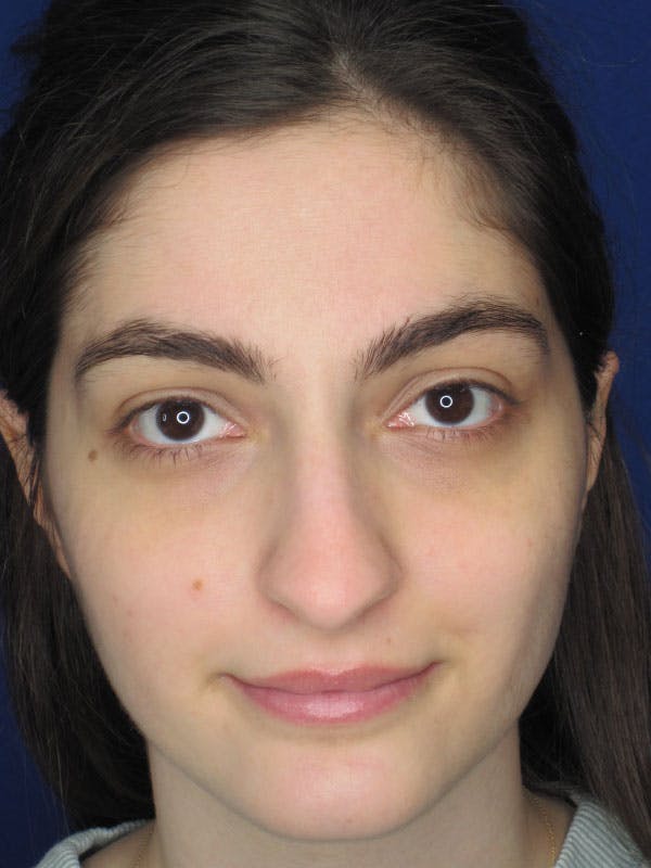 Rhinoplasty Before & After Gallery - Patient 92111732 - Image 5