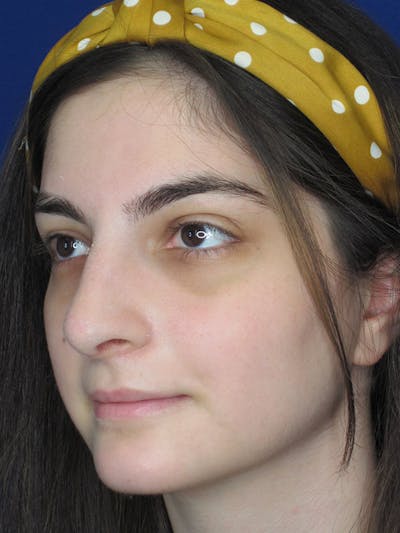 Rhinoplasty Before & After Gallery - Patient 92111732 - Image 8