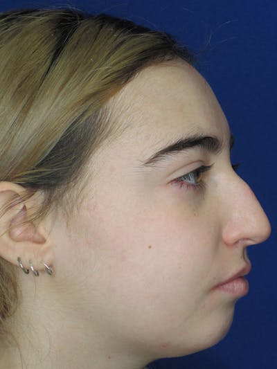 Rhinoplasty Before & After Gallery - Patient 92111738 - Image 1
