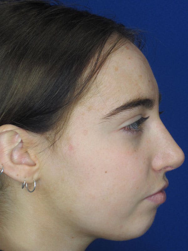Rhinoplasty Before & After Gallery - Patient 92111738 - Image 2