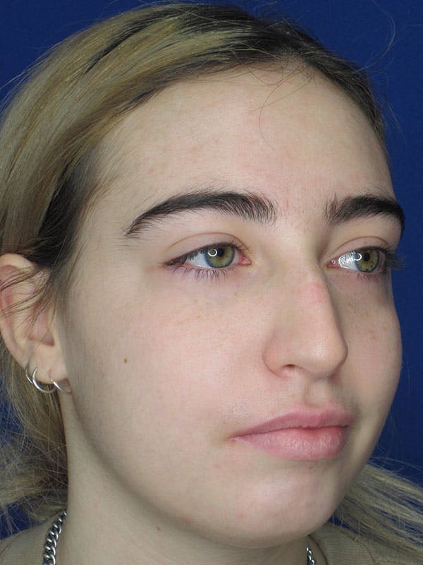 Rhinoplasty Before & After Gallery - Patient 92111738 - Image 3