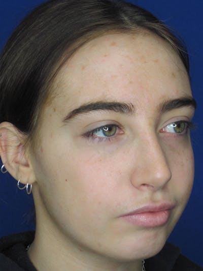 Rhinoplasty Before & After Gallery - Patient 92111738 - Image 4