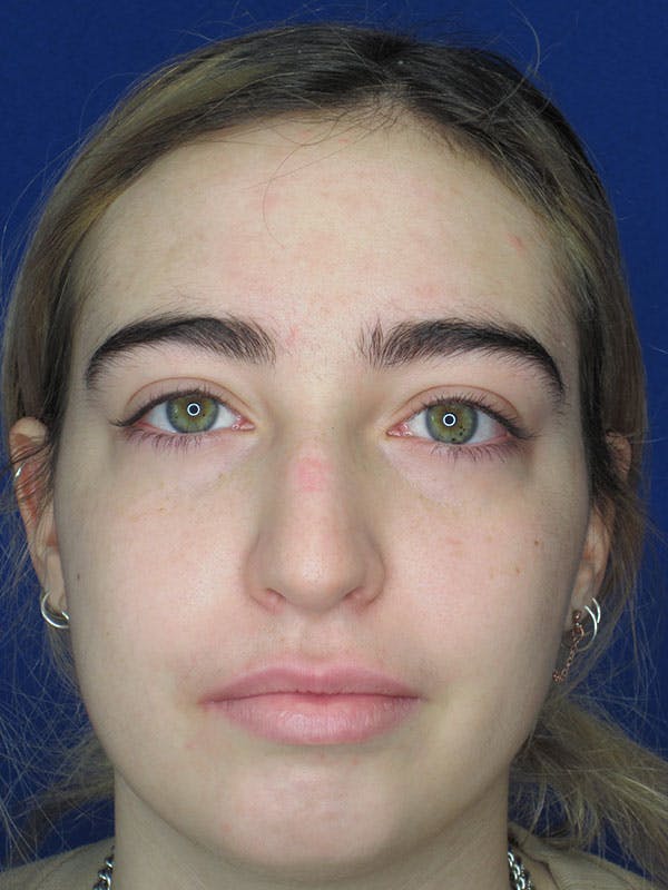 Rhinoplasty Before & After Gallery - Patient 92111738 - Image 5