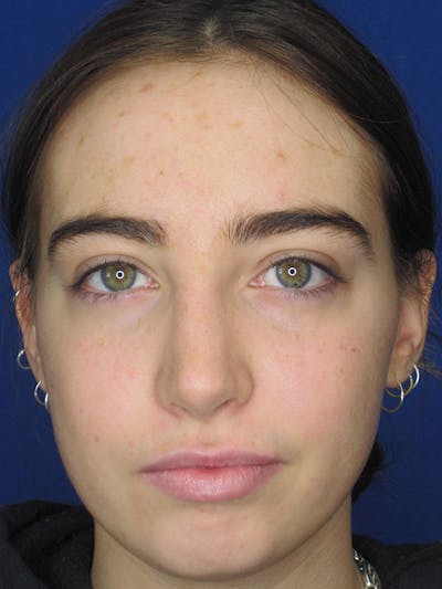 Rhinoplasty Before & After Gallery - Patient 92111738 - Image 6
