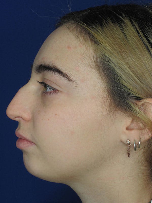 Rhinoplasty Before & After Gallery - Patient 92111738 - Image 7