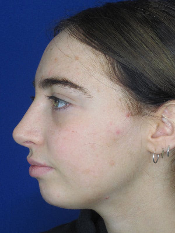 Rhinoplasty Before & After Gallery - Patient 92111738 - Image 8