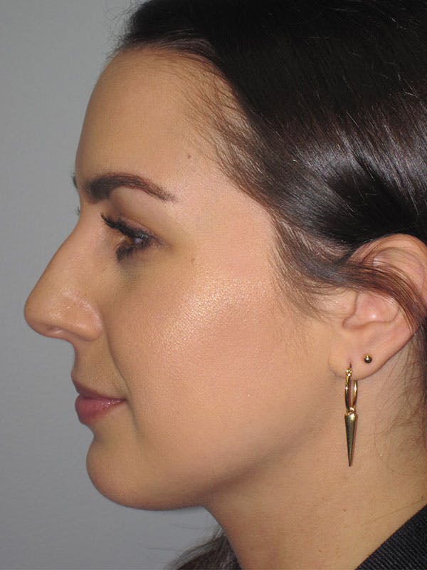 Rhinoplasty Before & After Gallery - Patient 92111739 - Image 1