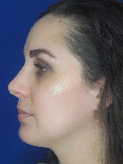 Rhinoplasty Before & After Gallery - Patient 92111739 - Image 2