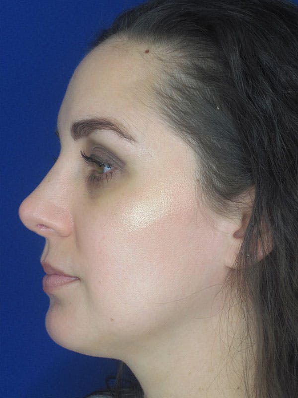 Rhinoplasty Before & After Gallery - Patient 92111739 - Image 2