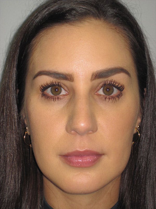 Rhinoplasty Before & After Gallery - Patient 92111739 - Image 3