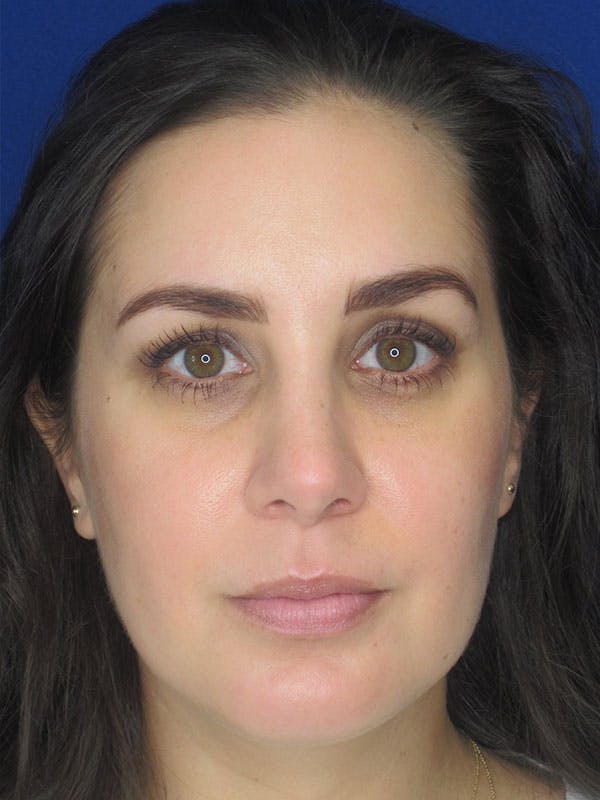 Rhinoplasty Before & After Gallery - Patient 92111739 - Image 4