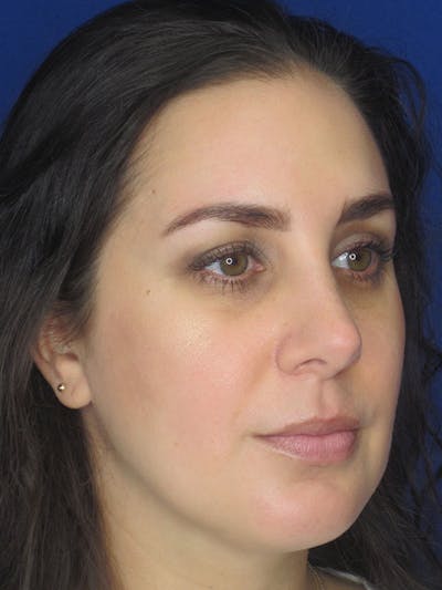 Rhinoplasty Before & After Gallery - Patient 92111739 - Image 6
