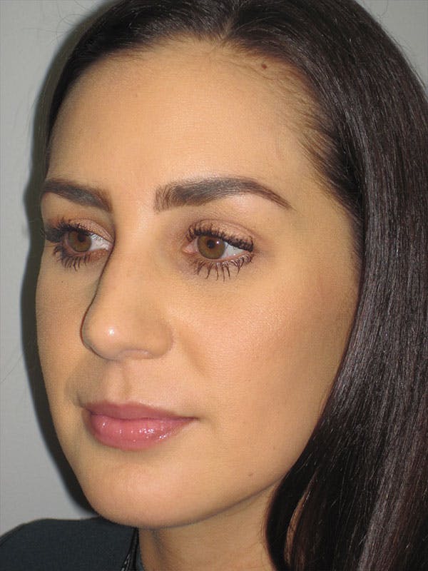 Rhinoplasty Before & After Gallery - Patient 92111739 - Image 7