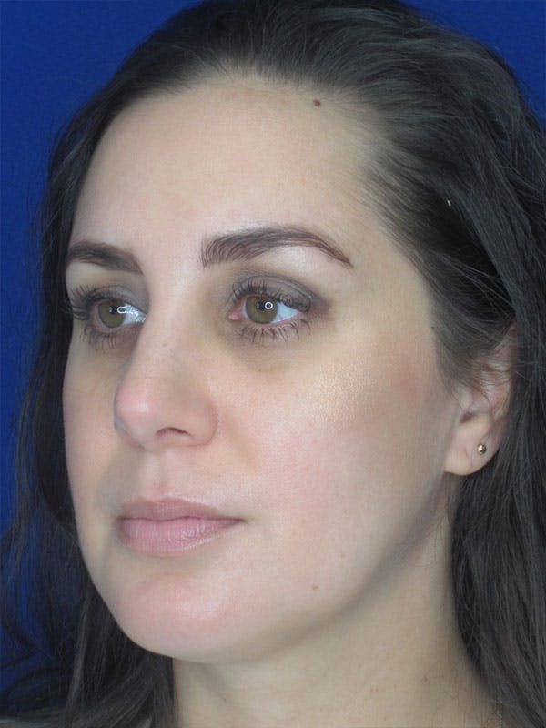 Rhinoplasty Before & After Gallery - Patient 92111739 - Image 8