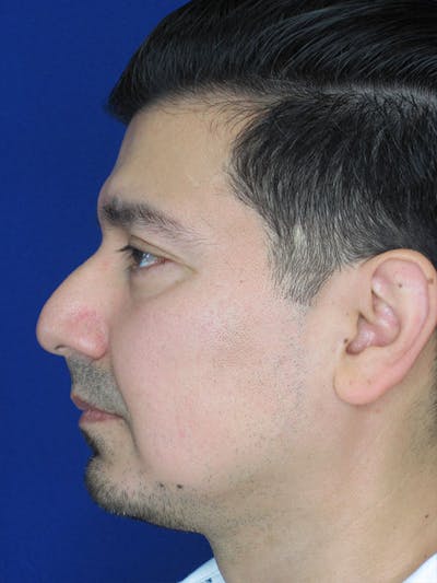 Rhinoplasty Before & After Gallery - Patient 92111775 - Image 1