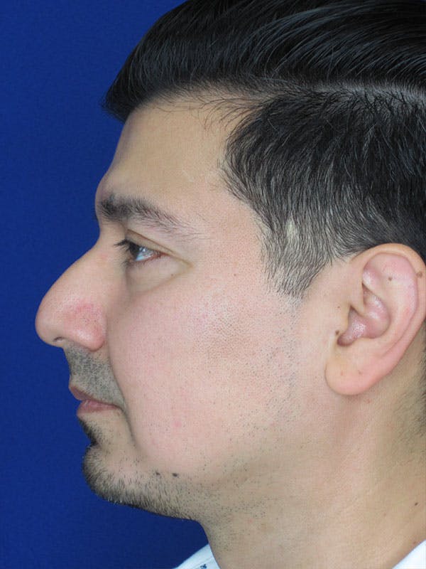 Rhinoplasty Before & After Gallery - Patient 92111775 - Image 1