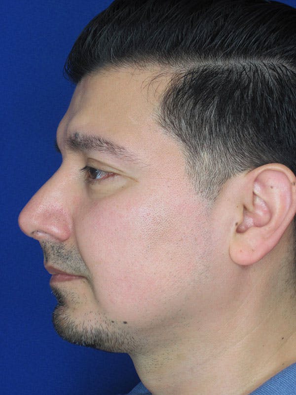 Rhinoplasty Before & After Gallery - Patient 92111775 - Image 2