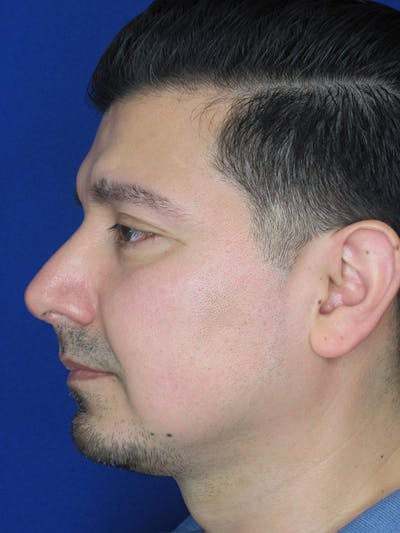 Rhinoplasty Before & After Gallery - Patient 92111775 - Image 2