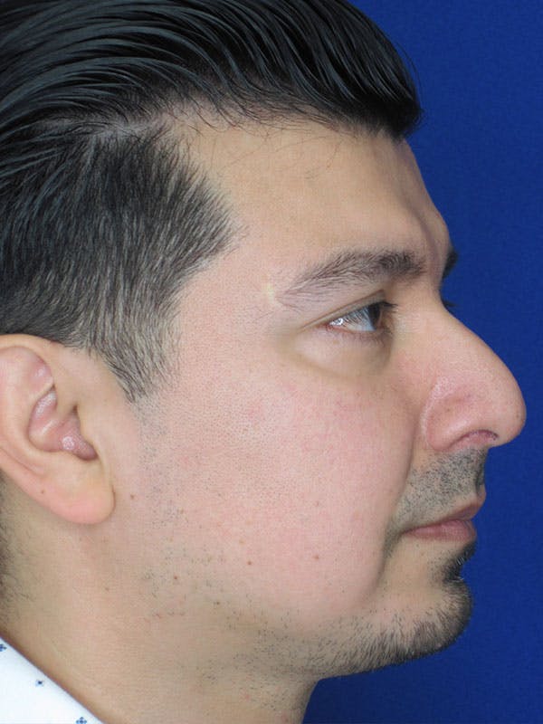 Rhinoplasty Before & After Gallery - Patient 92111775 - Image 7