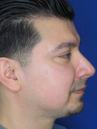 Rhinoplasty Before & After Gallery - Patient 92111775 - Image 8