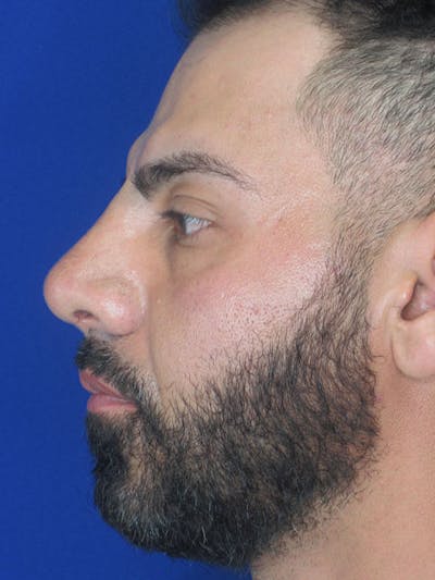 Rhinoplasty Before & After Gallery - Patient 92111778 - Image 2
