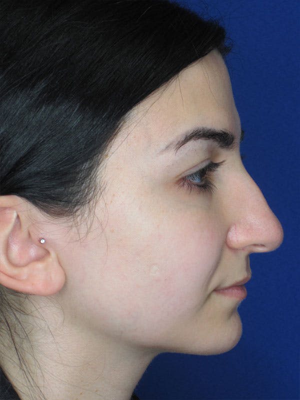 Rhinoplasty Before & After Gallery - Patient 92114923 - Image 1