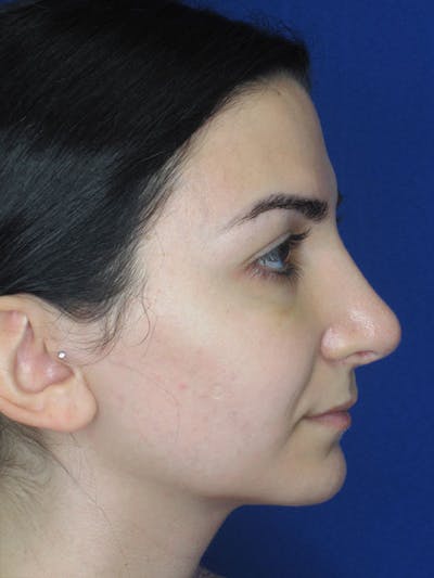 Rhinoplasty Before & After Gallery - Patient 92114923 - Image 2
