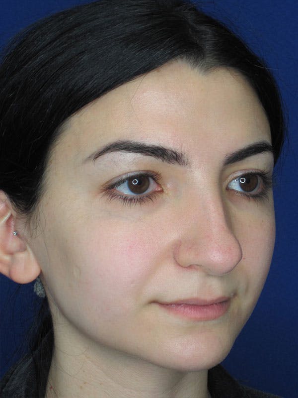 Rhinoplasty Before & After Gallery - Patient 92114923 - Image 3