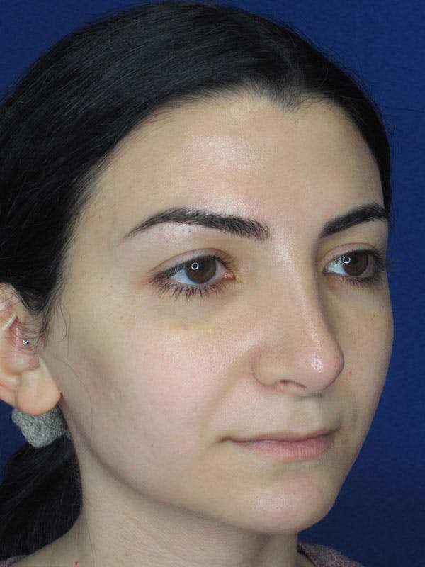 Rhinoplasty Before & After Gallery - Patient 92114923 - Image 4
