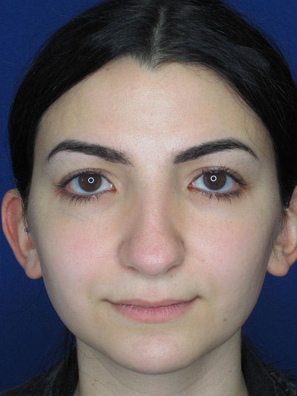Rhinoplasty Before & After Gallery - Patient 92114923 - Image 5