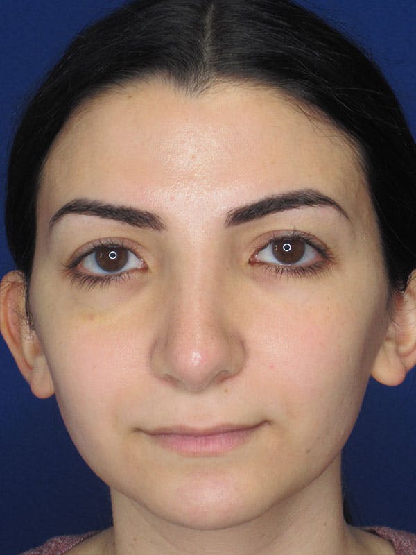 Rhinoplasty Before & After Gallery - Patient 92114923 - Image 6