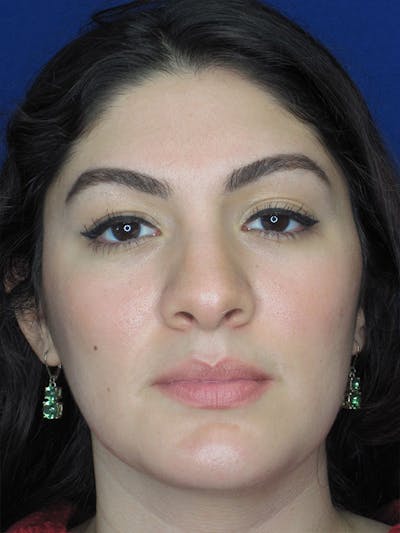 Rhinoplasty Before & After Gallery - Patient 92114934 - Image 1