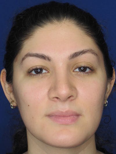 Rhinoplasty Before & After Gallery - Patient 92114934 - Image 2