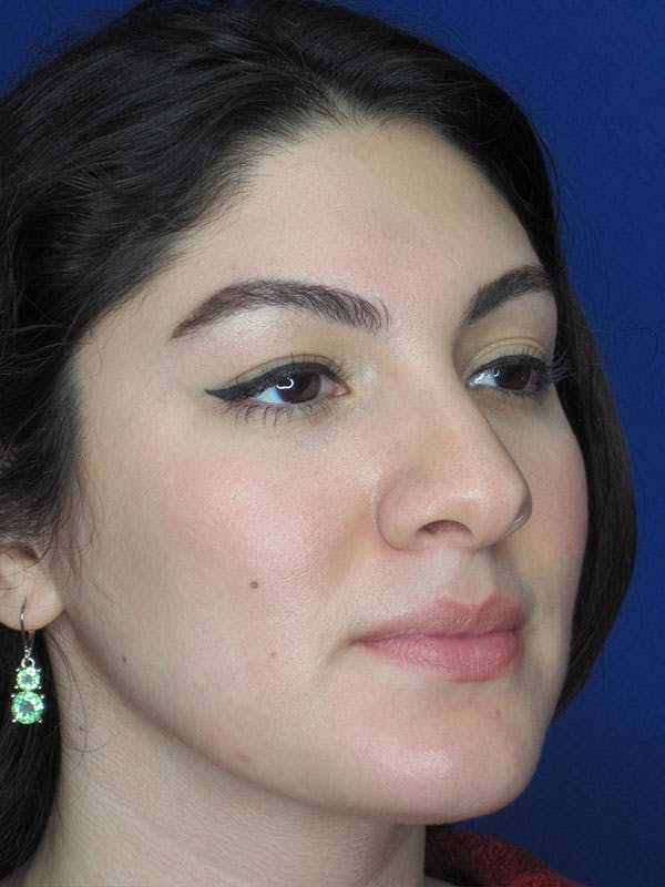Rhinoplasty Before & After Gallery - Patient 92114934 - Image 3