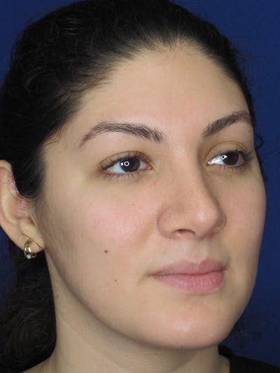 Rhinoplasty Before & After Gallery - Patient 92114934 - Image 4
