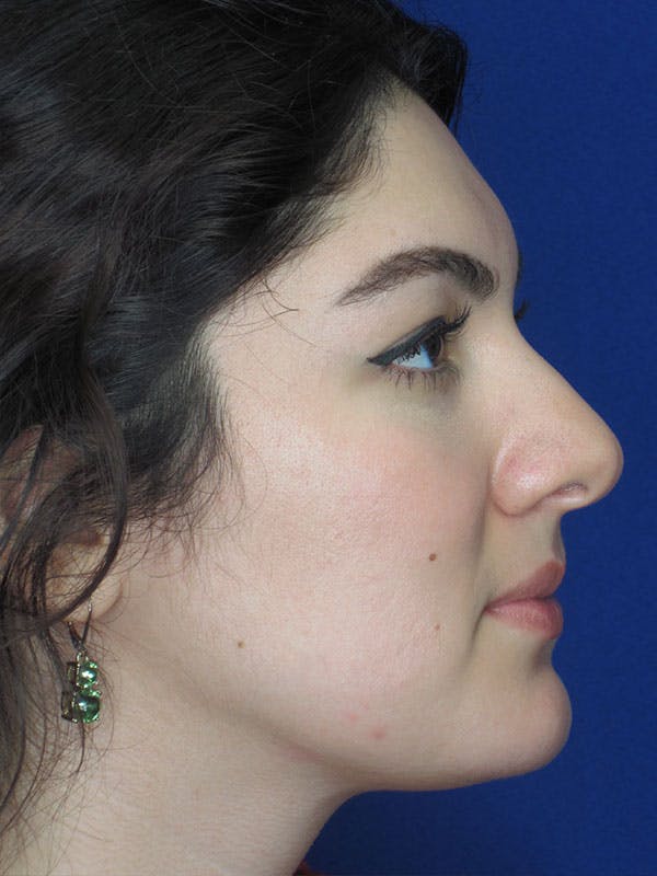 Rhinoplasty Before & After Gallery - Patient 92114934 - Image 5