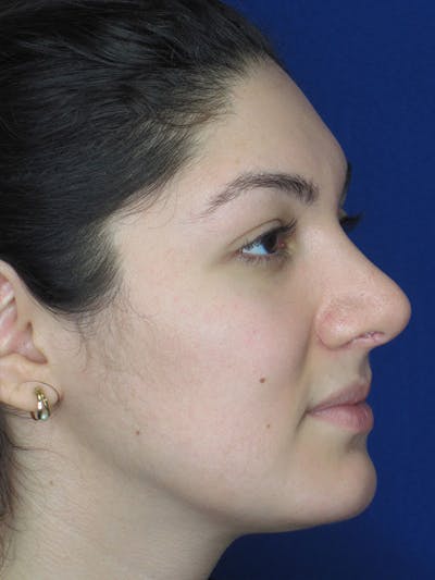 Rhinoplasty Before & After Gallery - Patient 92114934 - Image 6