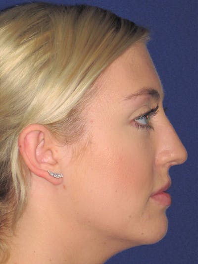 Rhinoplasty Before & After Gallery - Patient 92114945 - Image 1