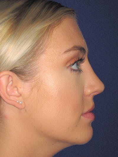 Rhinoplasty Before & After Gallery - Patient 92114945 - Image 2