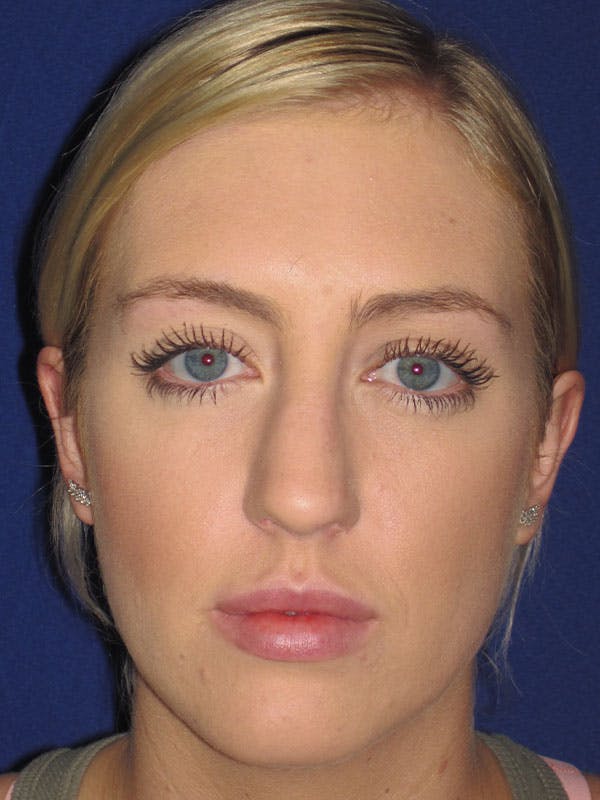 Rhinoplasty Before & After Gallery - Patient 92114945 - Image 3