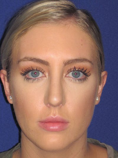 Rhinoplasty Before & After Gallery - Patient 92114945 - Image 4