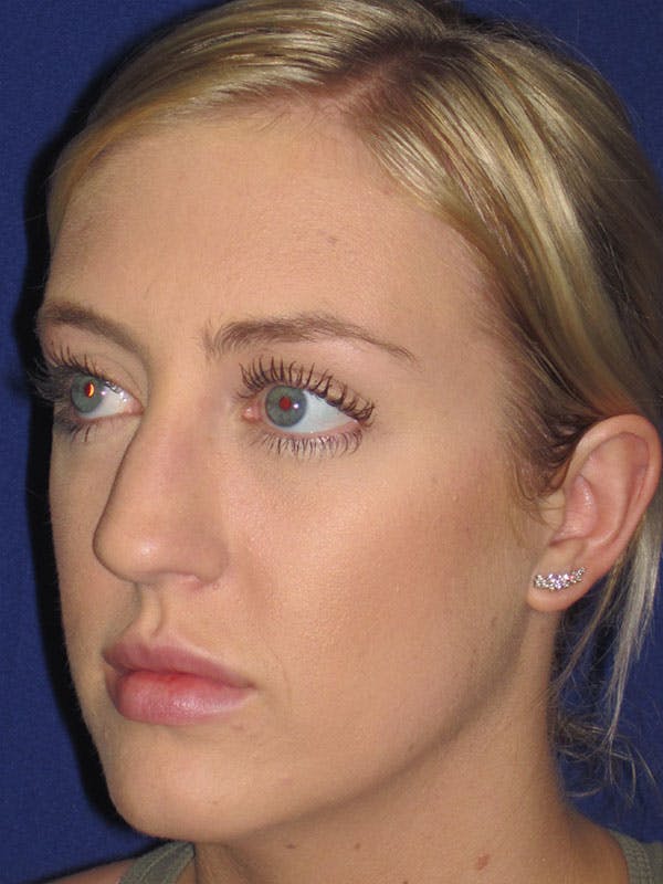 Rhinoplasty Before & After Gallery - Patient 92114945 - Image 5