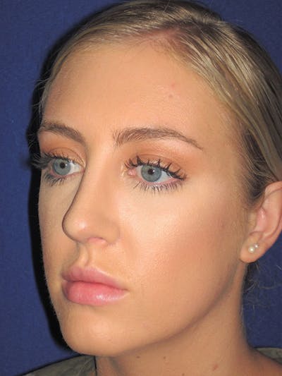 Rhinoplasty Before & After Gallery - Patient 92114945 - Image 6