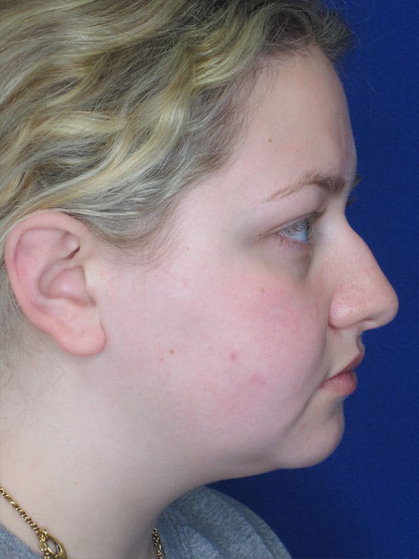 Rhinoplasty Before & After Gallery - Patient 92114967 - Image 3