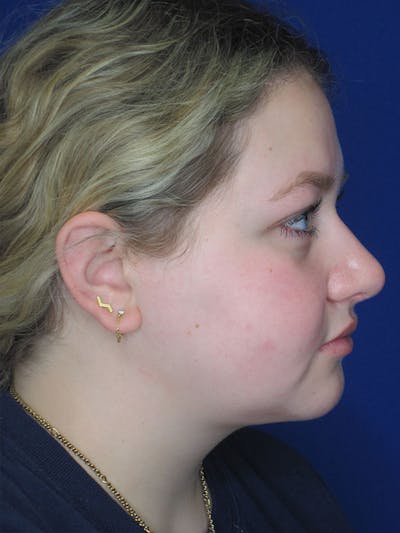 Rhinoplasty Before & After Gallery - Patient 92114967 - Image 4
