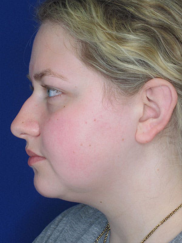 Rhinoplasty Before & After Gallery - Patient 92114967 - Image 5