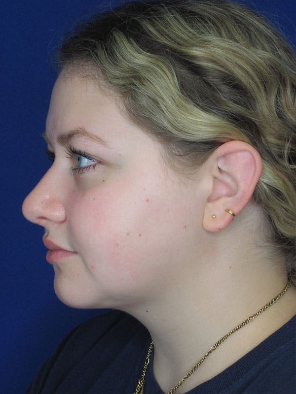 Rhinoplasty Before & After Gallery - Patient 92114967 - Image 6