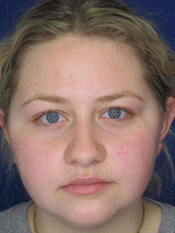 Rhinoplasty Before & After Gallery - Patient 92114967 - Image 7