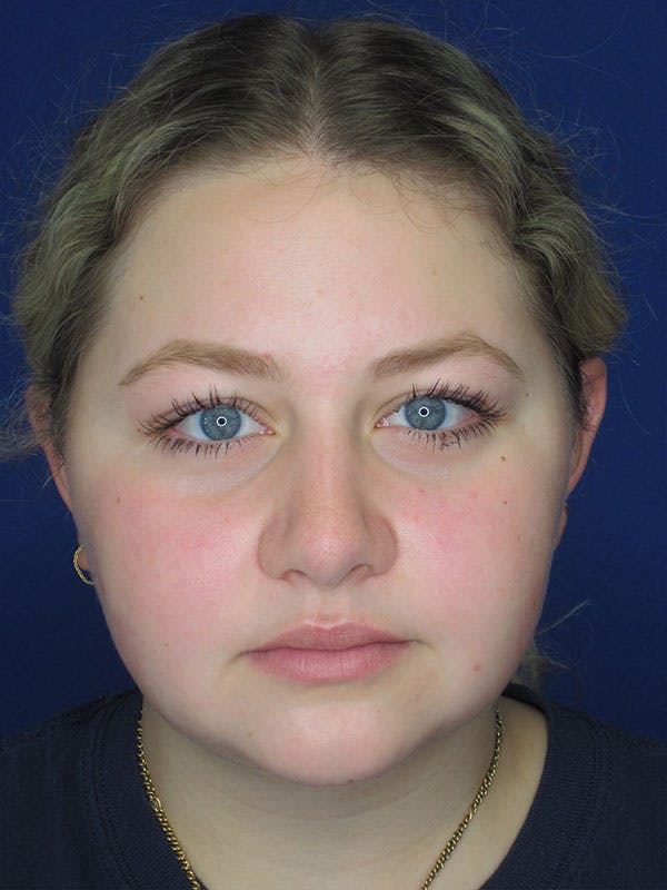 Rhinoplasty Before & After Gallery - Patient 92114967 - Image 8