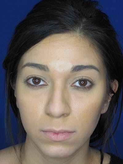 Rhinoplasty Before & After Gallery - Patient 92118122 - Image 1